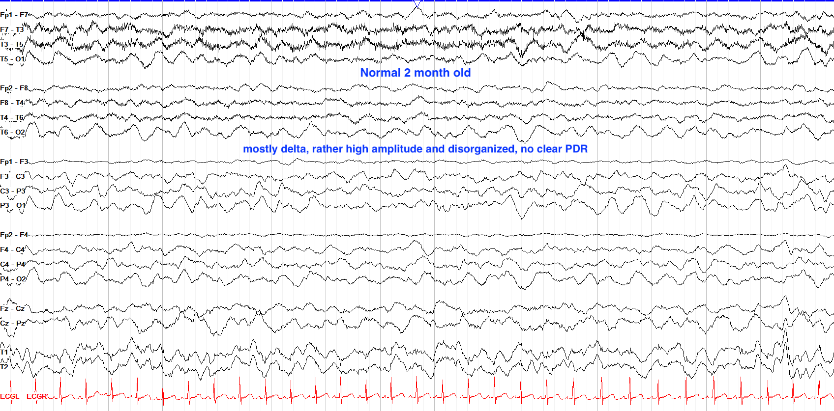 eeg 2011年 The Pediatric EEG